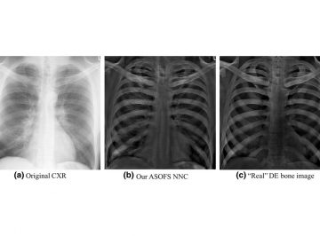 【Published】Separation of Bones from Soft Tissue in Chest Radiographs: Anatomy-specific Orientation-frequency-specific Deep Neural Network Convolution