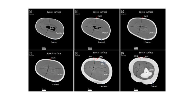 X-ray micro-computed tomography for teeth enamel damage evaluation