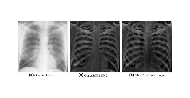 【論文】Separation of Bones from Soft Tissue in Chest Radiographs: Anatomy-specific Orientation-frequency-specific Deep Neural Network Convolution