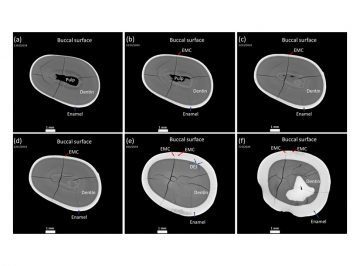 X-ray micro-computed tomography for teeth enamel damage evaluation